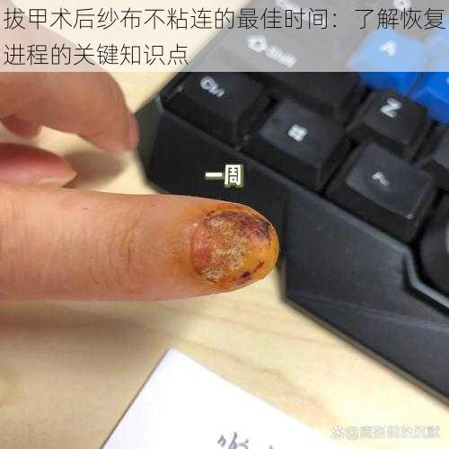 拔甲术后纱布不粘连的最佳时间:了解恢复进程的关键知识点