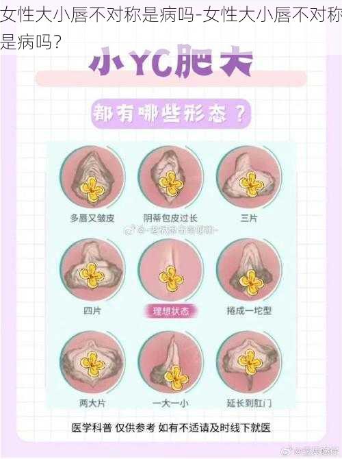 女性大小唇不对称是病吗-女性大小唇不对称是病吗?